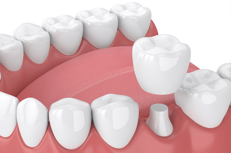 Dental Crowns in Matawan