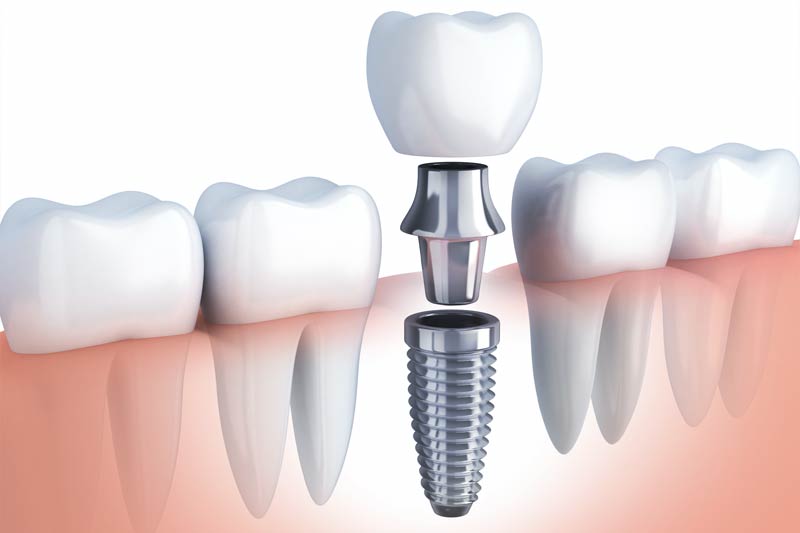 Implants Dentist in Matawan