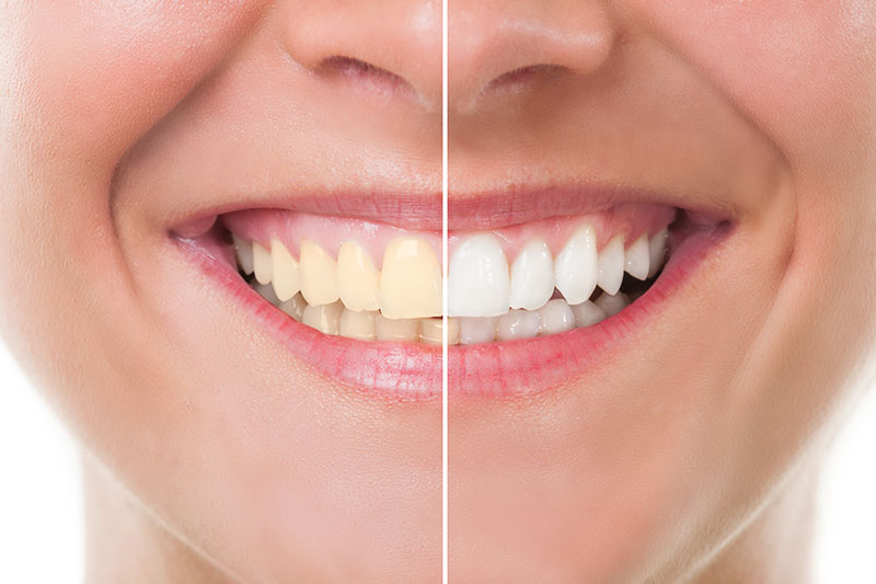 Teeth Whitening in Matawan