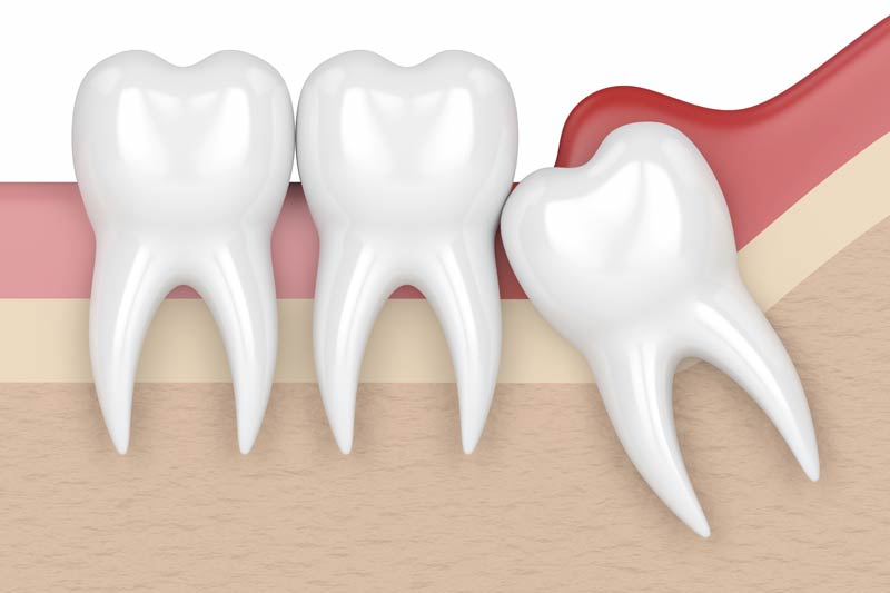 Wisdom Tooth Removal in Matawan